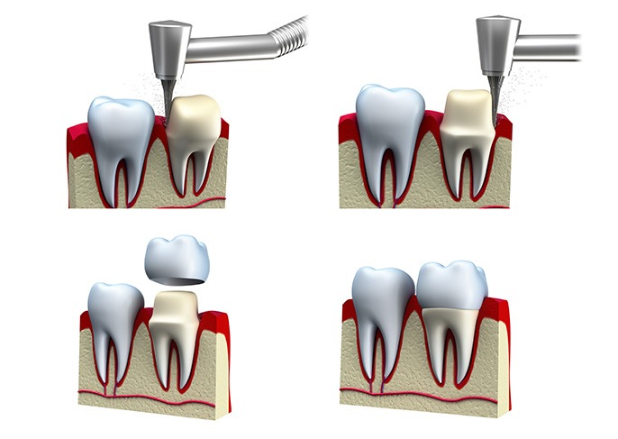 Dental Crown Process Fort McMurray | Family and General Dentistry Fort McMurray | Eagle Ridge Dental