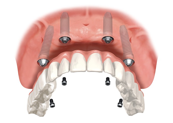 Fort McMurray Overdenture Implants | Fort McMurray General Dentist Services | Eagle Ridge Dental