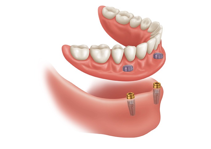 Fort McMurray Overdenture Implants | General Dentist Services | Eagle Ridge Dental