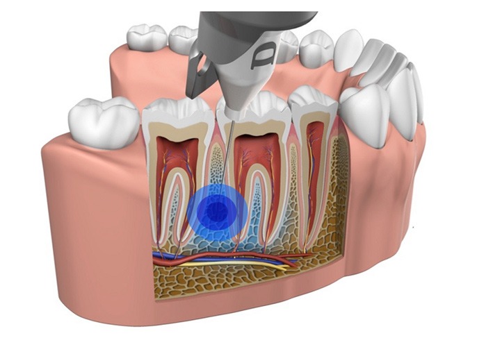 Fort McMurray Quicksleeper Anesthesia | General Dentistry Services | Eagle Ridge Dental