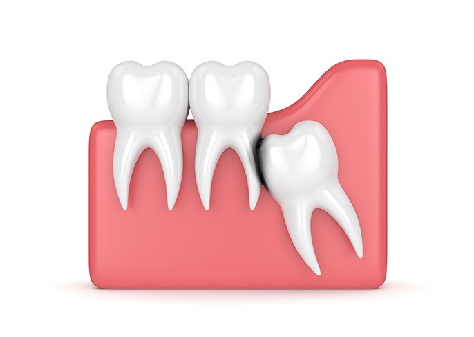 Teeth Extraction Fort McMurray AB | Fort McMurray General Dentistry Services | Eagle Ridge Dental